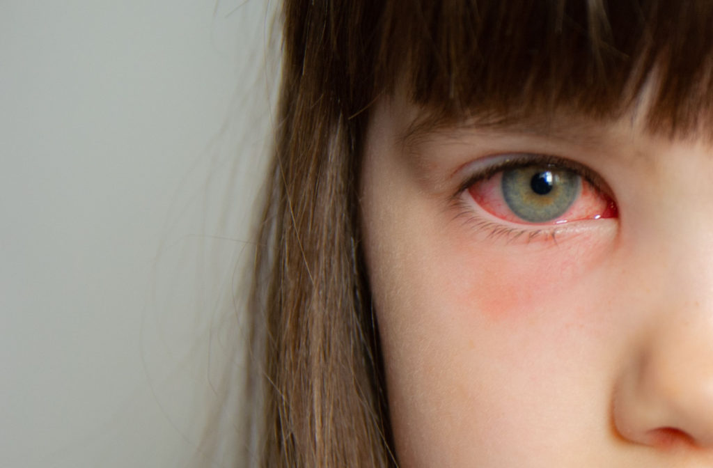 A close-up of a girl's right eye with conjuctivitis.