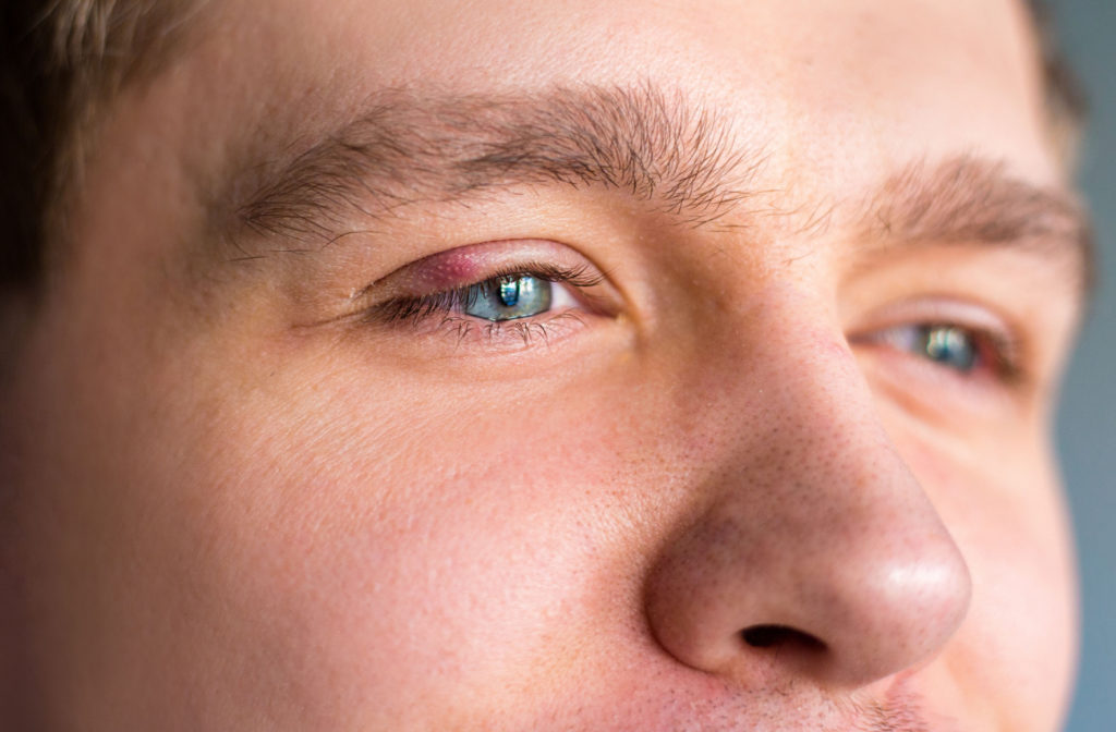 A close-up of man's face with a stye on his right upper eyelid.