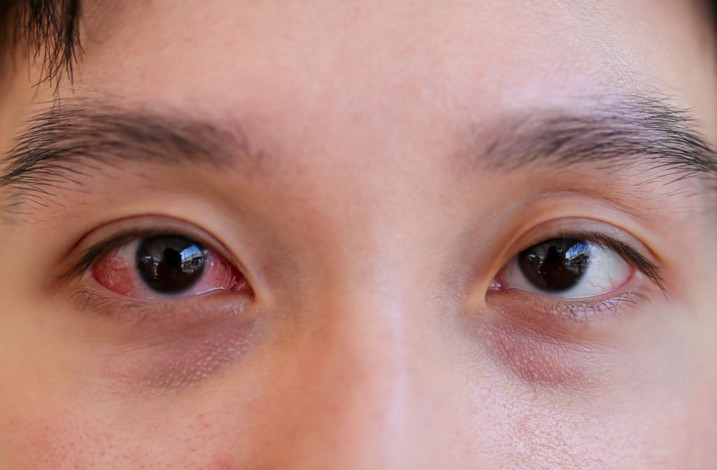 A close-up of a person's eyes with conjunctivitis.