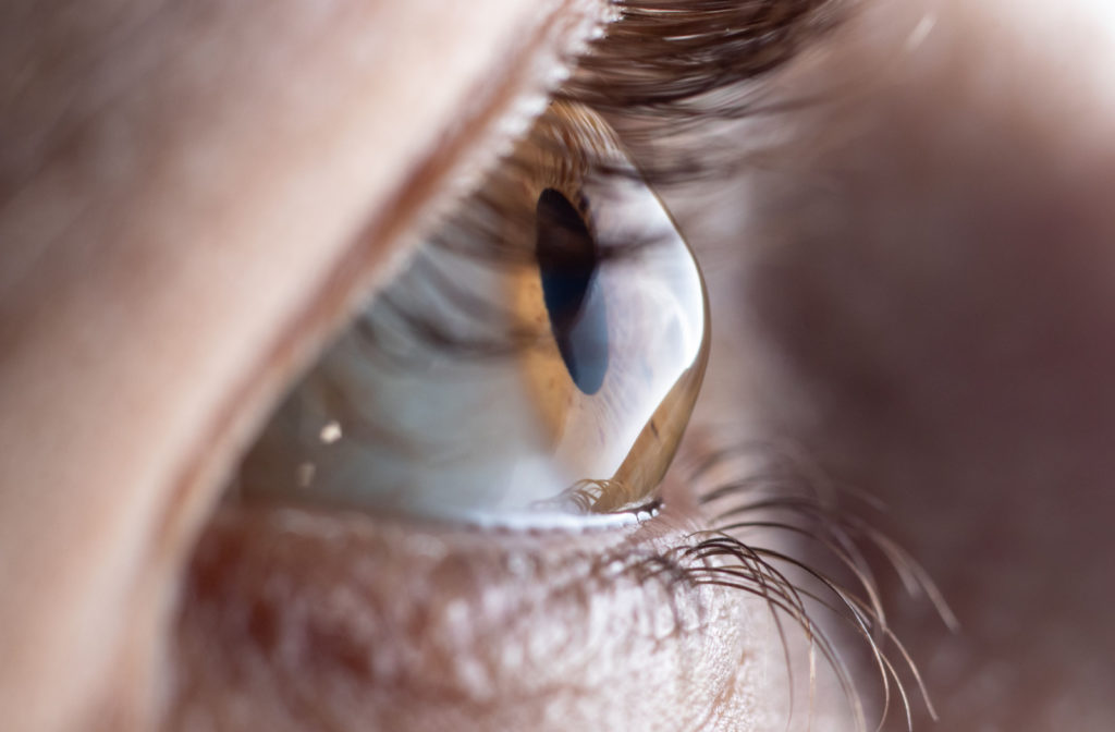 A close up of an eye with keratoconus.